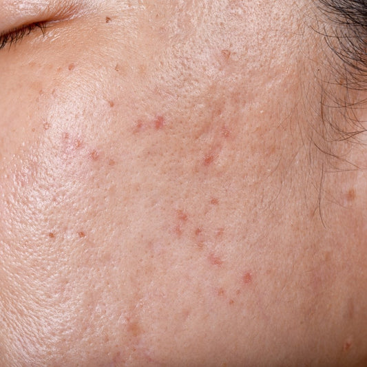 Acne treatment for adults: what causes acne in adults and how to treat acne. - PORE FAVOR USA