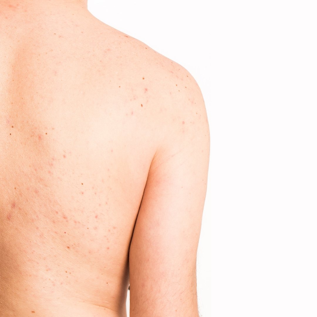 3 top treatments for back acne. What is back acne and how do we stop it?