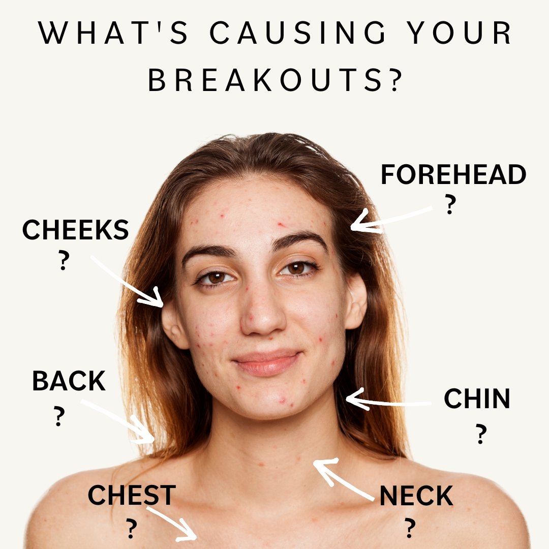 Could Acne Mapping Get Rid Of My Acne? An Experts Guide.