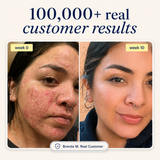 Acne Supplement