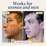 Acne Supplement
