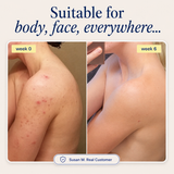 Acne Supplement