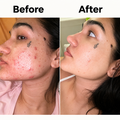 Acne Supplement