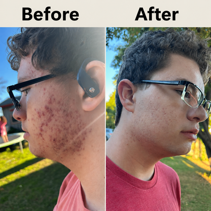 Acne Supplement