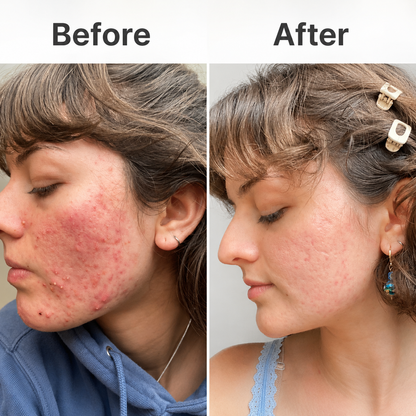 Acne Supplement
