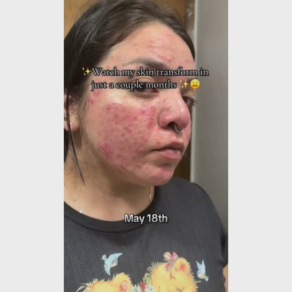 Acne Supplement